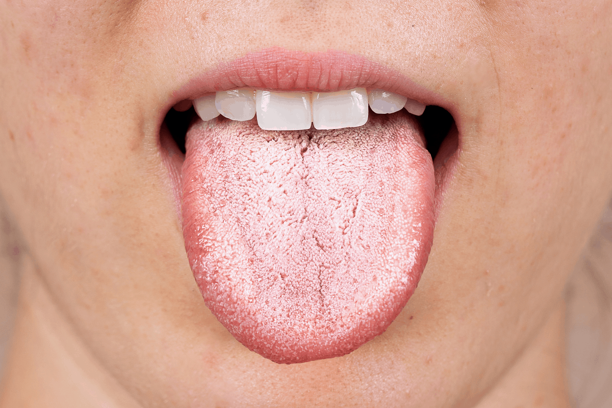 close up image of woman sticking out her tongue showing thick, white coating due to Candida or other yeast overgrowth