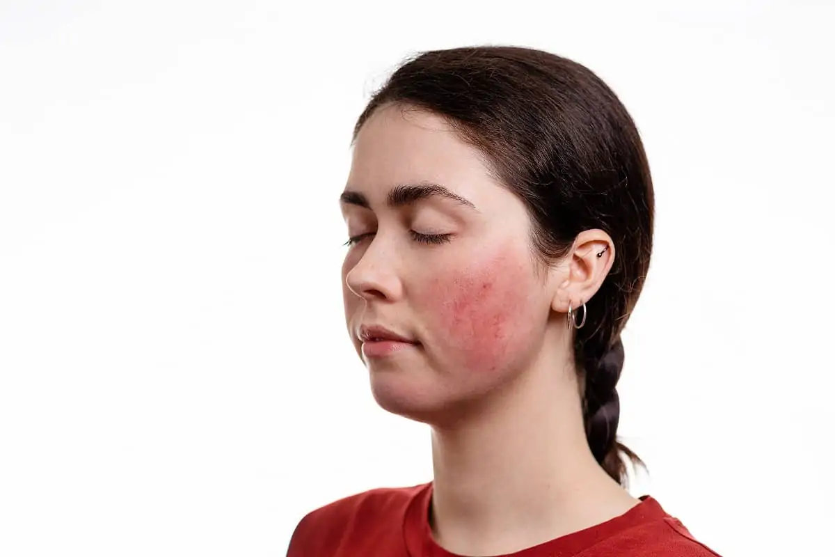 Caucasian brunette woman, profile view with her eyes closed and red patch of rosacea on cheek