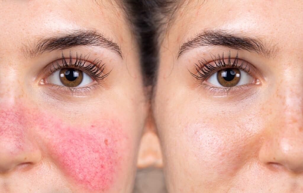 close up side by side image of woman's face before and after addressing root causes of her rosacea