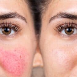 close up side by side image of woman's face before and after addressing root causes of her rosacea