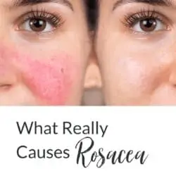 Collage - before and after photo of Caucasian woman with rosacea and title text overlay