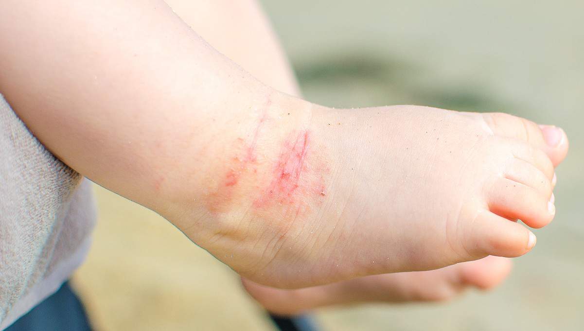 Eczema on baby's foot being exposed to sunlight
