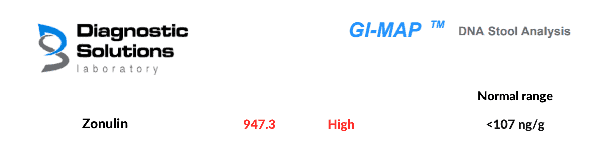 section of GI MAP stool test showing high zonulin as indicator of Leaky Gut