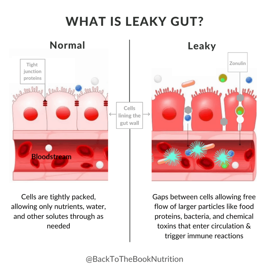 Graphic comparing a Leaky Gut to normal gut